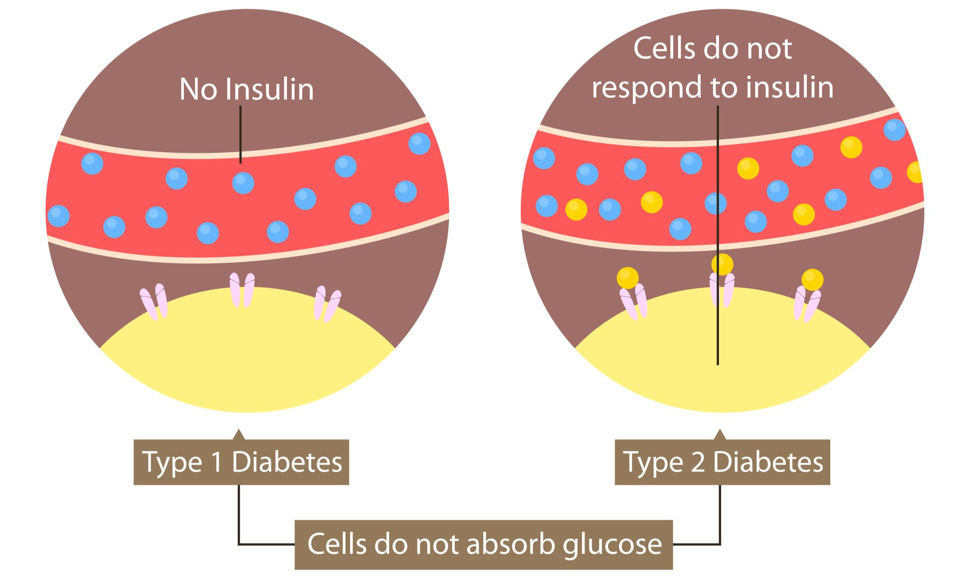Types of diabetes (type 1 and type 2)