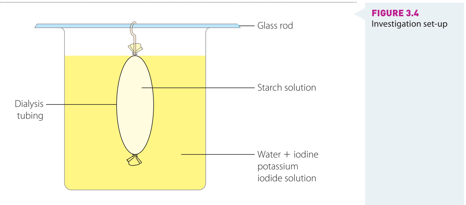 Peritoneal dialysis illustration