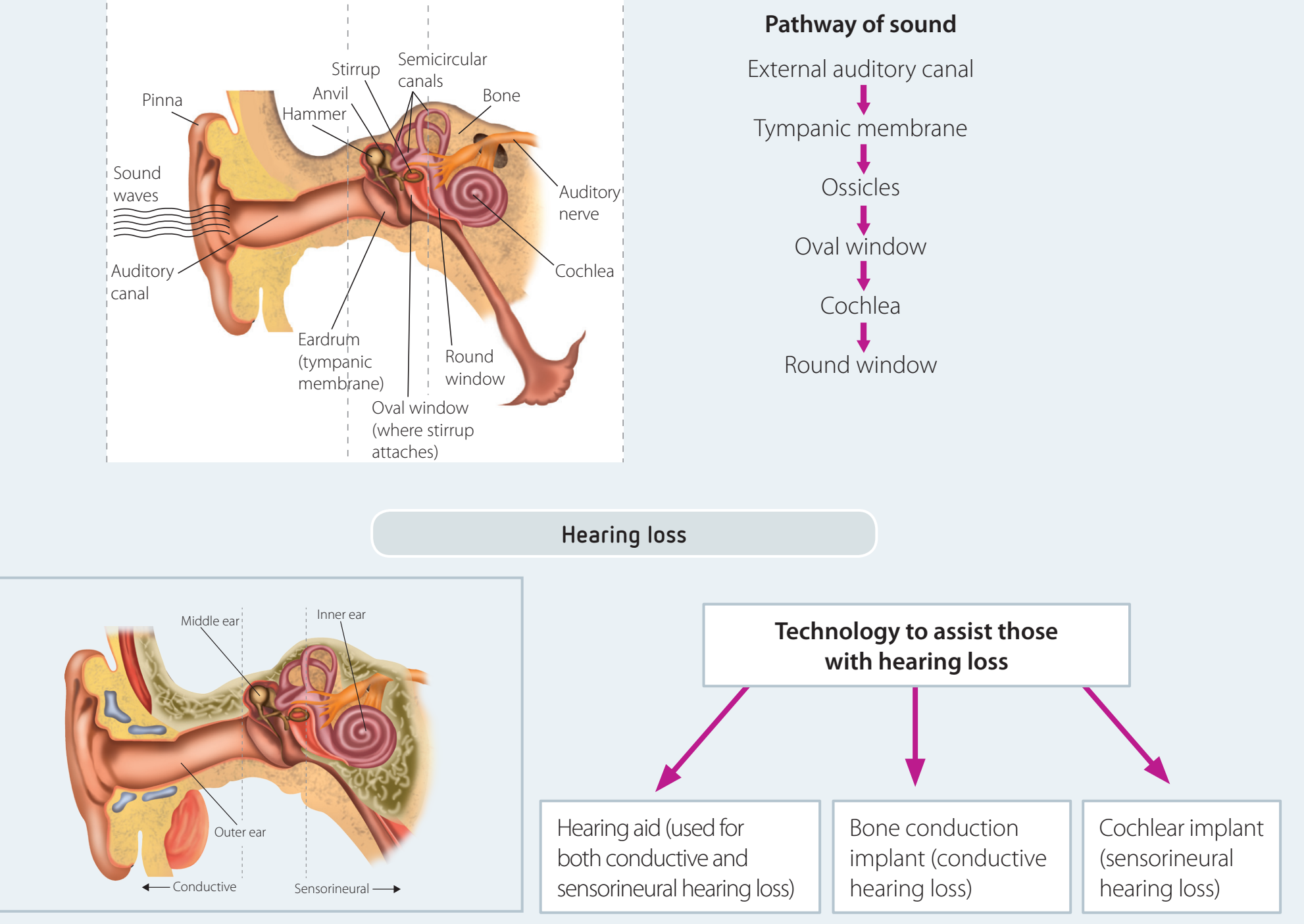 Cochlear Implant Diagram depicting components such as microphone, speech processor, and electrode array, illustrating basic functionality and placement.