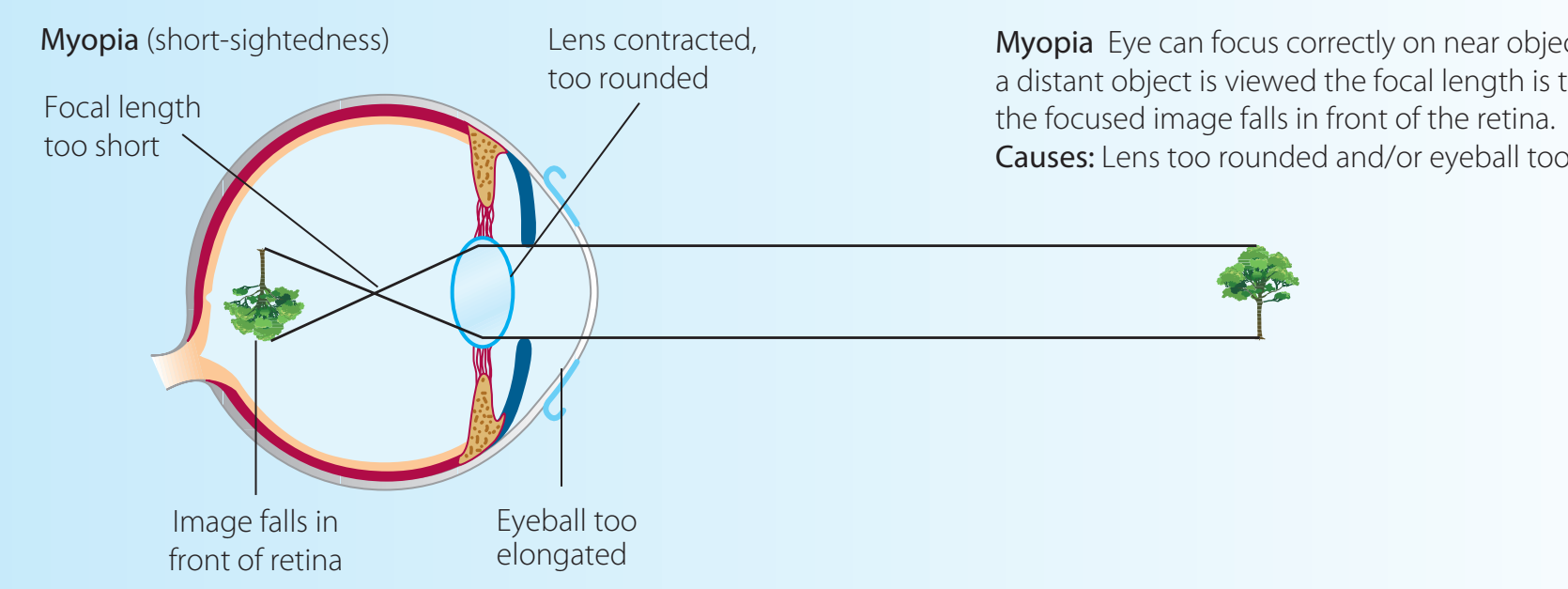 Diagram illustrating elongated eyeball causing light to focus in front of the retina in myopia.