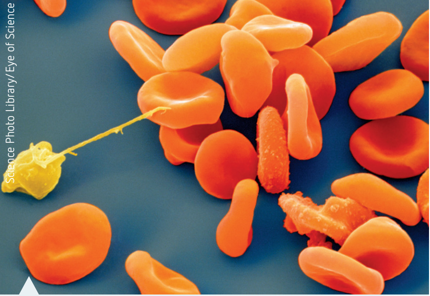 Diagram showing normal haemoglobin against sickle cell variant to illustrate harmful mutation effects.