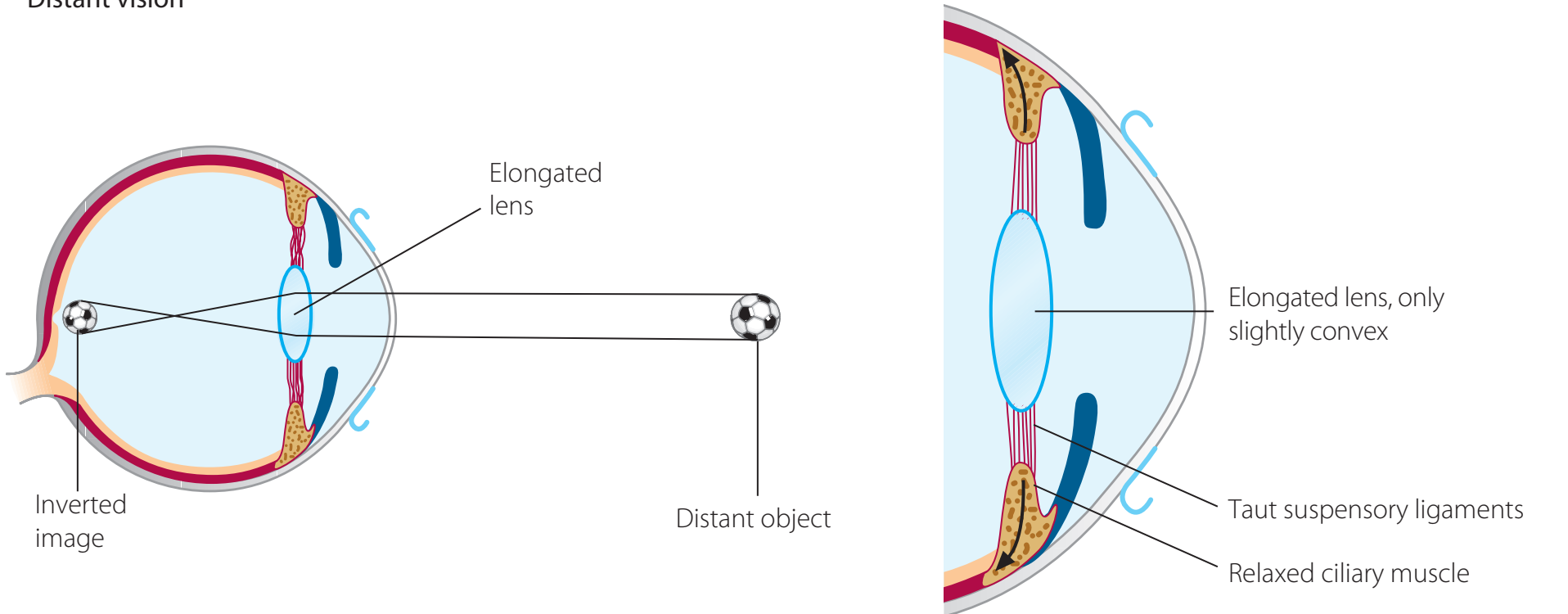 Diagram of shortened eyeball causing light to focus behind the retina.