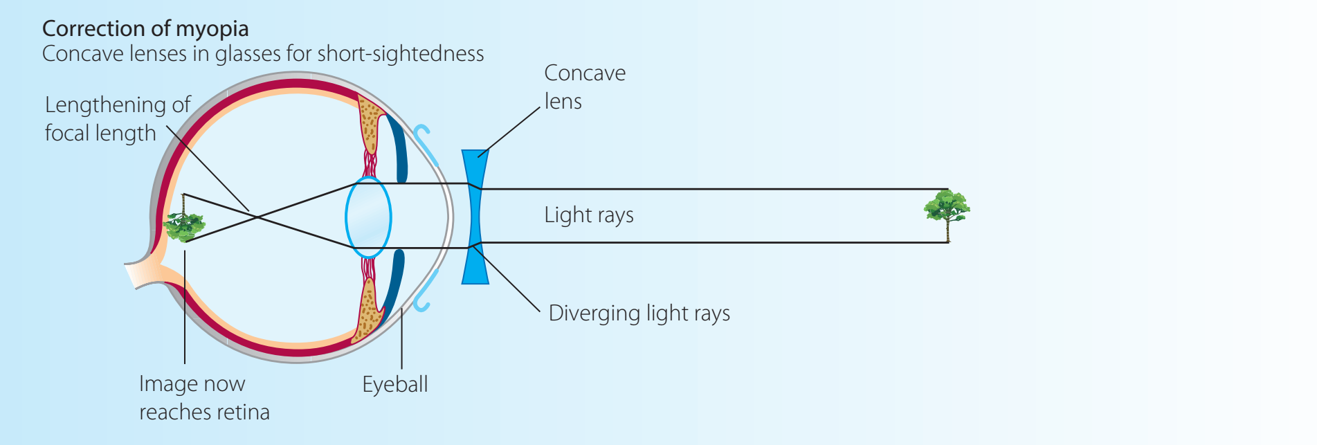 Diagram illustrating light paths through corrective lenses.